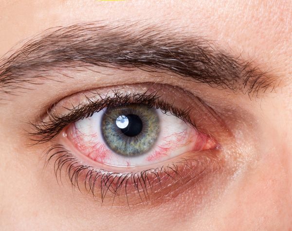 A kontaktlencse-allergia tünetei
