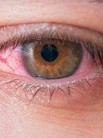 Amikor irul-pirul a szem: a kötőhártya-gyulladás tünetei, okai és kezelése