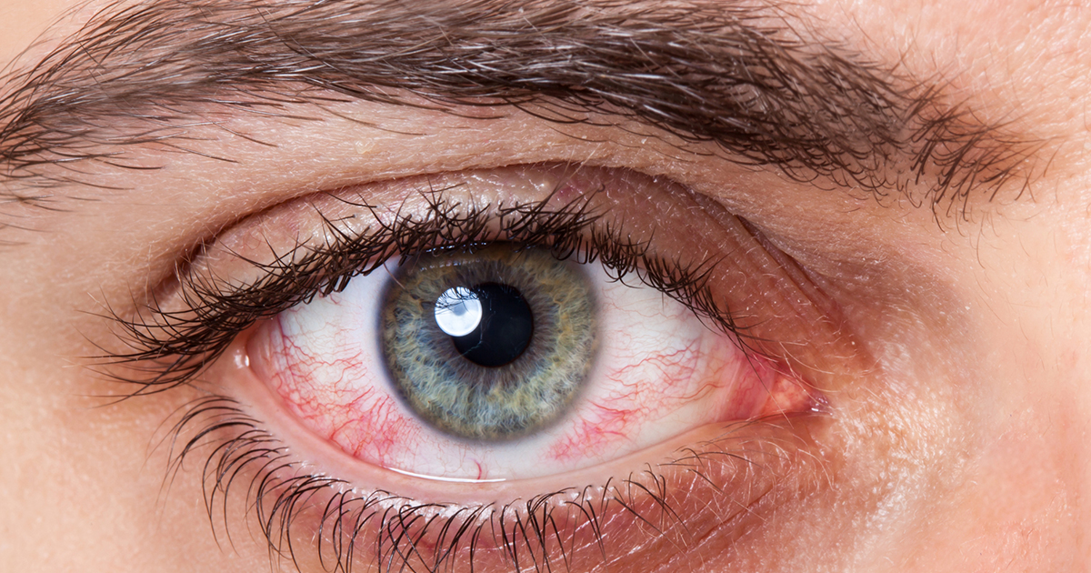 A szem vörössége magas vérnyomással. Szembevérzés tünetei és kezelése